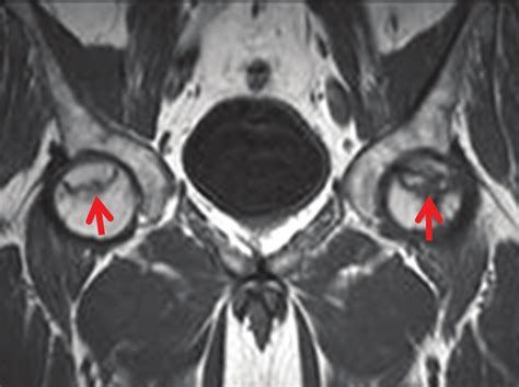 Coronal T1w Mr Image In A Patient With Bilateral Femoral Head
