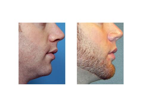 Jaw Angle And Chin Implants Dr Barry Eppley Indianapolis Explore