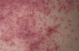Photos of What To Do For Heat Rash