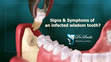 what are the signs symptoms and treatment for impacted wisdom teeth youtube