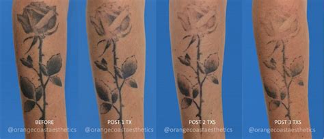 Frequently Asked Questions About Laser Tattoo Removal Orange Coast
