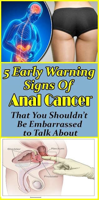 Early Warning Signs Anal Cancer That You Shouldnt Be Embarrassed To