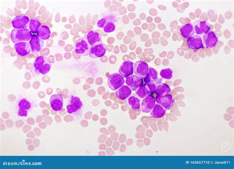 Acute Leukemia In A Blood Smear Hematology Stock Photo