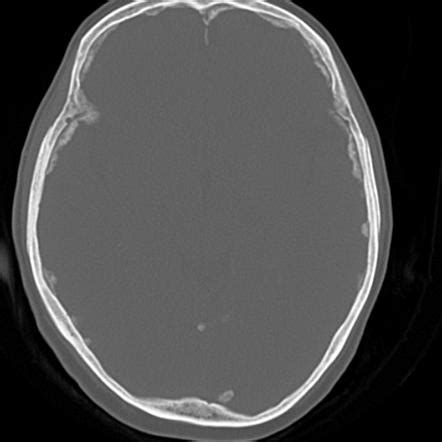 Diffuse Dural Calcification Radiology Reference Article Radiopaedia Org
