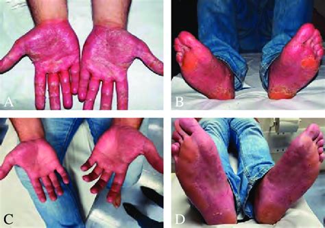 A B Diffuse Palms And Soles Erythema With Scaly Plaque Pasi 8 And
