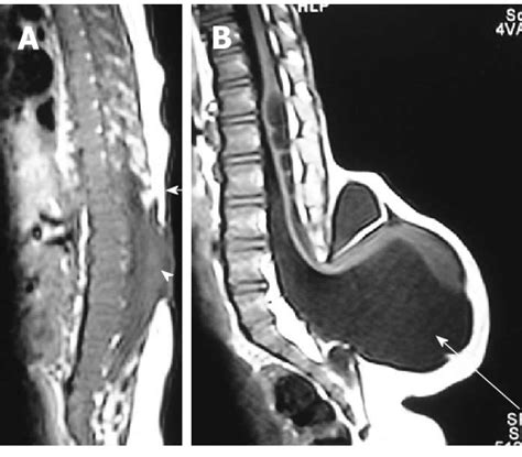 Myelocele And Myelomeningocele Sagittal T1 Weighted Images Of Spine In