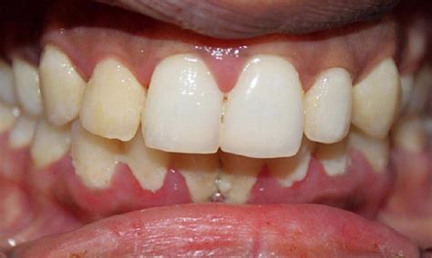 Periodontal Treatment Before And After Photos Vienna Va