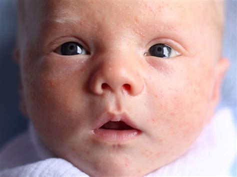 Medical News Today How To Identify Baby Acne Vs A Rash