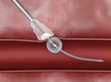 Advances And Trends In Vascular Closure Devices Daic