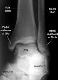 Emdocs Net Emergency Medicine Educationdiagnostic Accuracy Of Ankle X