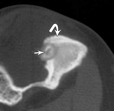 Intraarticular Osteoid Osteoma Sonographic Findings In Three Patients