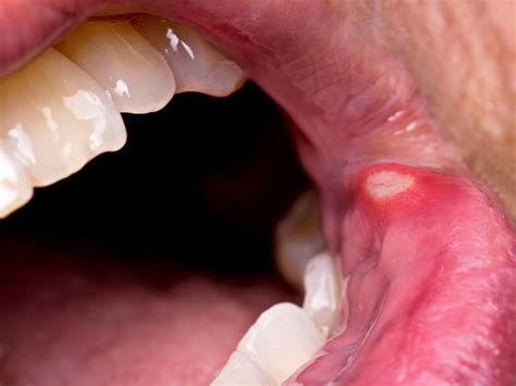 Hiv Mouth Sores How To Spot And Treat Them Health Plugged
