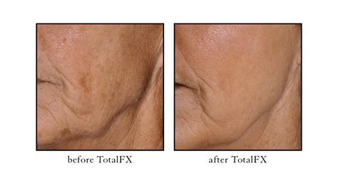 Fx Laser Skin Treatment Co2 Laser Cosmetic Skin And Laser Center