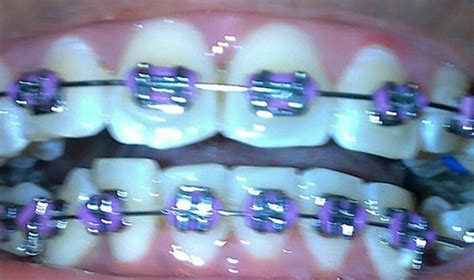 Cute Purple Braces For Teeth Braces Teeth Braces Braces Smile Braces Colors