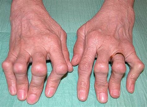 Polyarthritis Causes Symptoms Treatment Exercises And Medications