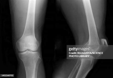 Black And White Knee Photos And Premium High Res Pictures Getty Images