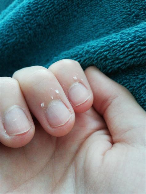What Causes The Peeling Around My Nails Rmedical