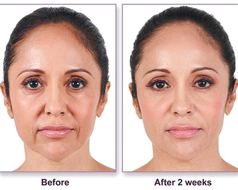 Facial Fillers Body Envi