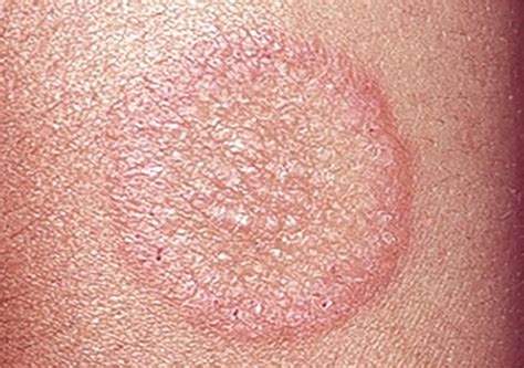 Diagnosis And Management Of Tinea Infections Aafp