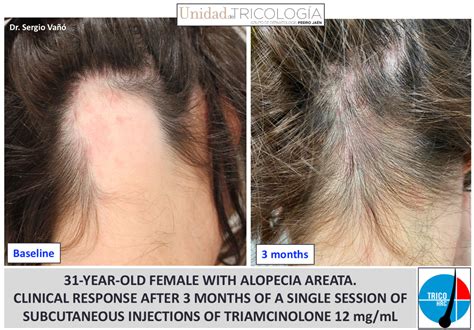 Alopecia Areata Soluci N Causas Problema Tratamiento Especialista
