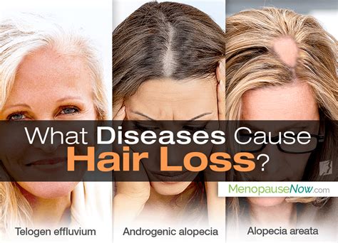 Details Diseases That Cause Hair Loss Best In Eteachers