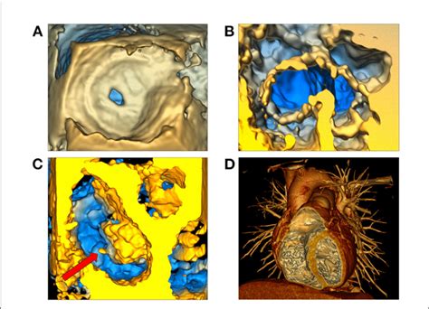 Figure E Volume Rendering Of Fd Echocardiographic And Tomographic Data