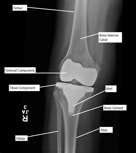 Swelling After Total Knee Replacement Complete Orthopedics