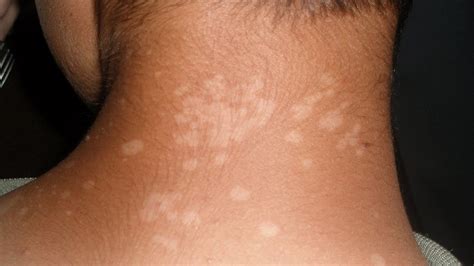 Tinea Versicolor Symptoms Causes Treatment And Prevention