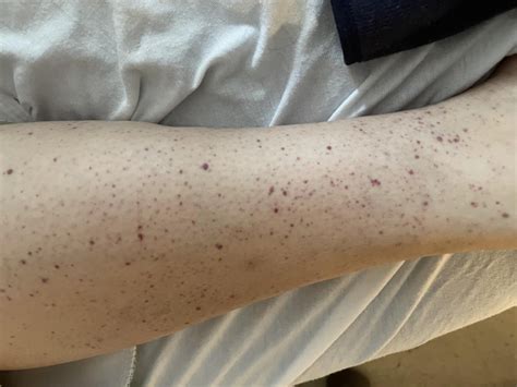 Diffuse Petechial Rash On The Patients Lower Extremities The Right