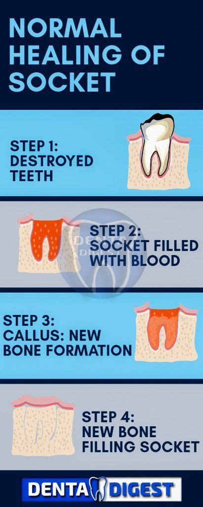 Normal Tooth Socket Healing In 2020 Dry Socket Tooth Extraction
