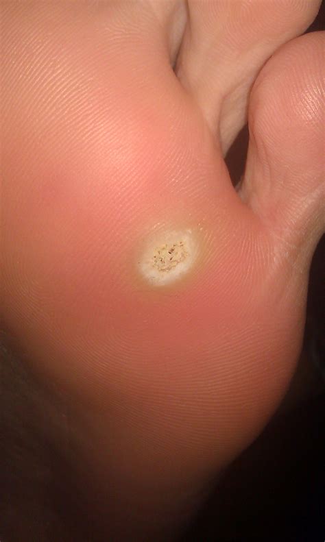 Plantar Wart Or Corn Pictures Plant Ideas