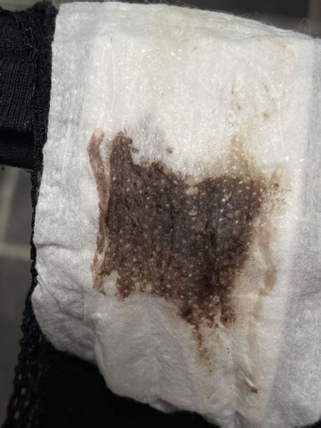 Very Dark Brown Discharge Pictures Included Mumsnet