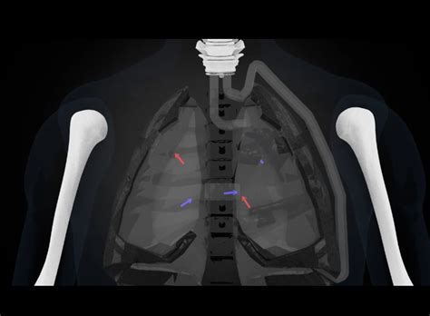 Artificial Lung Air Flow Device Newswire