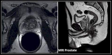 Prostate Cancer Ct Scan With Contrast Acute Pancreatitis Radiology