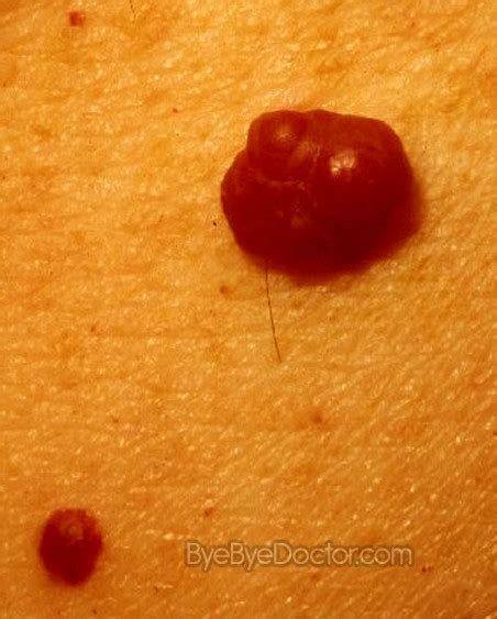 Cherry Angioma Causes And Treatment What Is A Cherry Angioma Causes Treatment And Removal