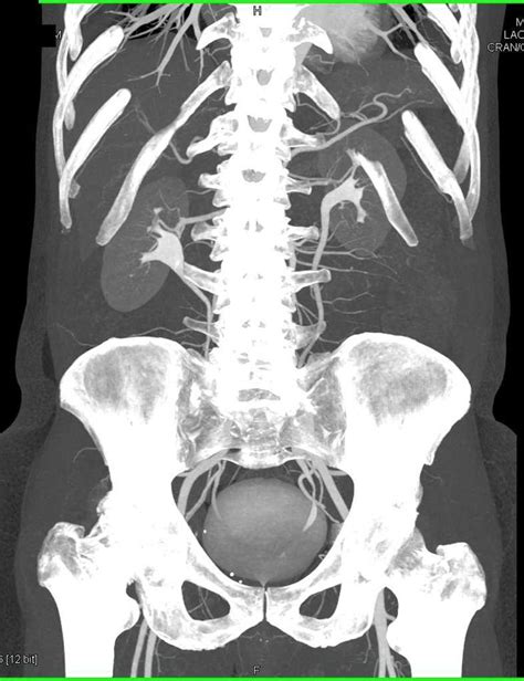 Ct Urogram With Mild Medial Positioning Of The Ureters