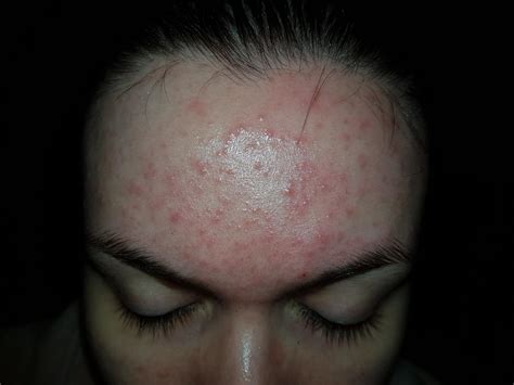 Red Irritating Bumps Mainly On Forehead Please Help Me With Photo Adult Acne