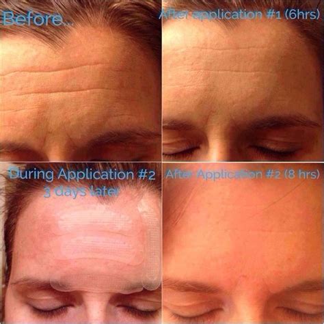 Before And After Acute Care On Forehead Wrinkles The Doctor Skin Care