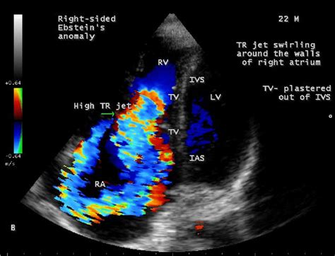 Apical Four Chamber View Showing The Severe High Tricuspid