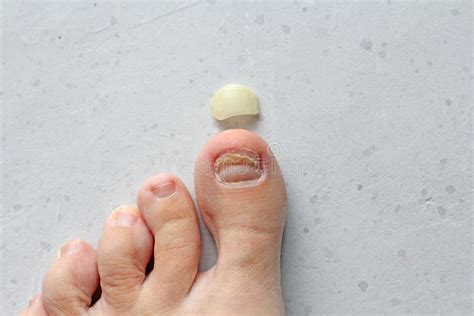 Exfoliation Of Nail On Big Toe Close Up In Woman Girl Toenail Damage