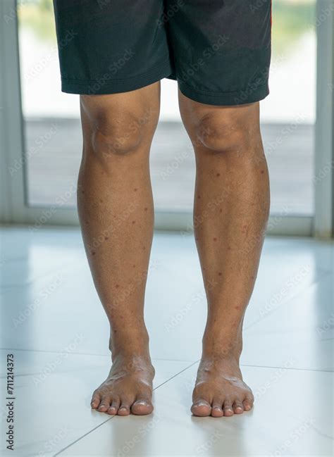 Midge Bite Marks On A Male Legs Feet And Legs Of A Man With Midge Bites Bitten By Hundreds Of