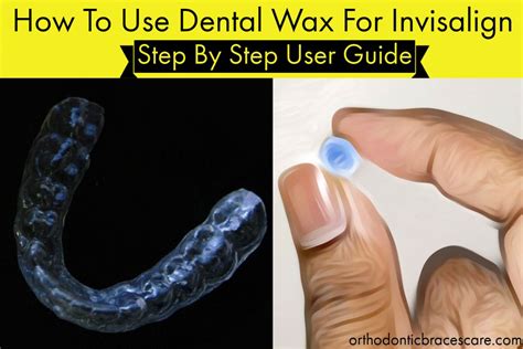 Can You Use Dental Wax On Invisalign Or Clear Aligners