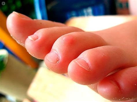 Claw Toe What Is It Symptoms And Treatment Top Doctors