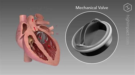 Heart Valve Replacement Options Youtube