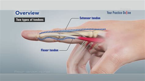 Acute Injuries To The Flexor And Extensor Tendons Of The Hand Surgery My Xxx Hot Girl