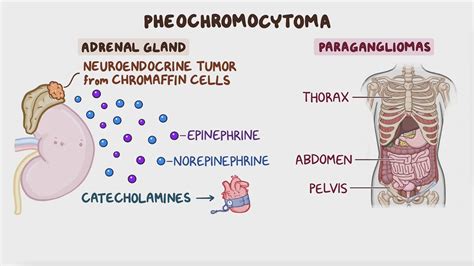 Pheochromocytoma Clinical Sciences Osmosis Video Library