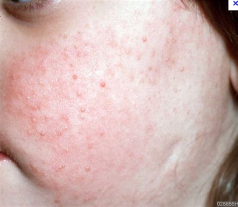 Top 105 Pictures Keratosis Pilaris Amlactin Before And After Pictures