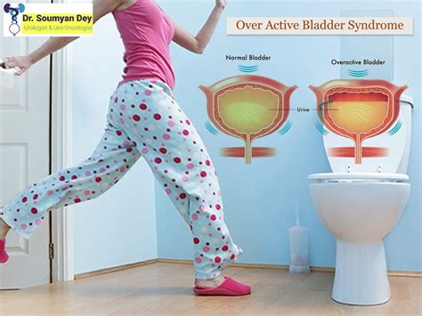 Symptoms Causes Treatment Of Overactive Bladder Syndrome