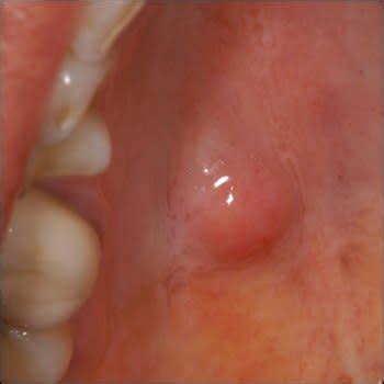 Bump on roof of mouth that randomly appeared with a little pain. Little Red Dots On Roof Of Mouth Sore Throat - Latest Rooftop Ideas