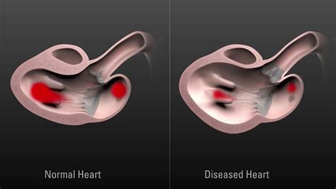 Comparison Of Normal Heart And Diseased Heart Cycles Youtube